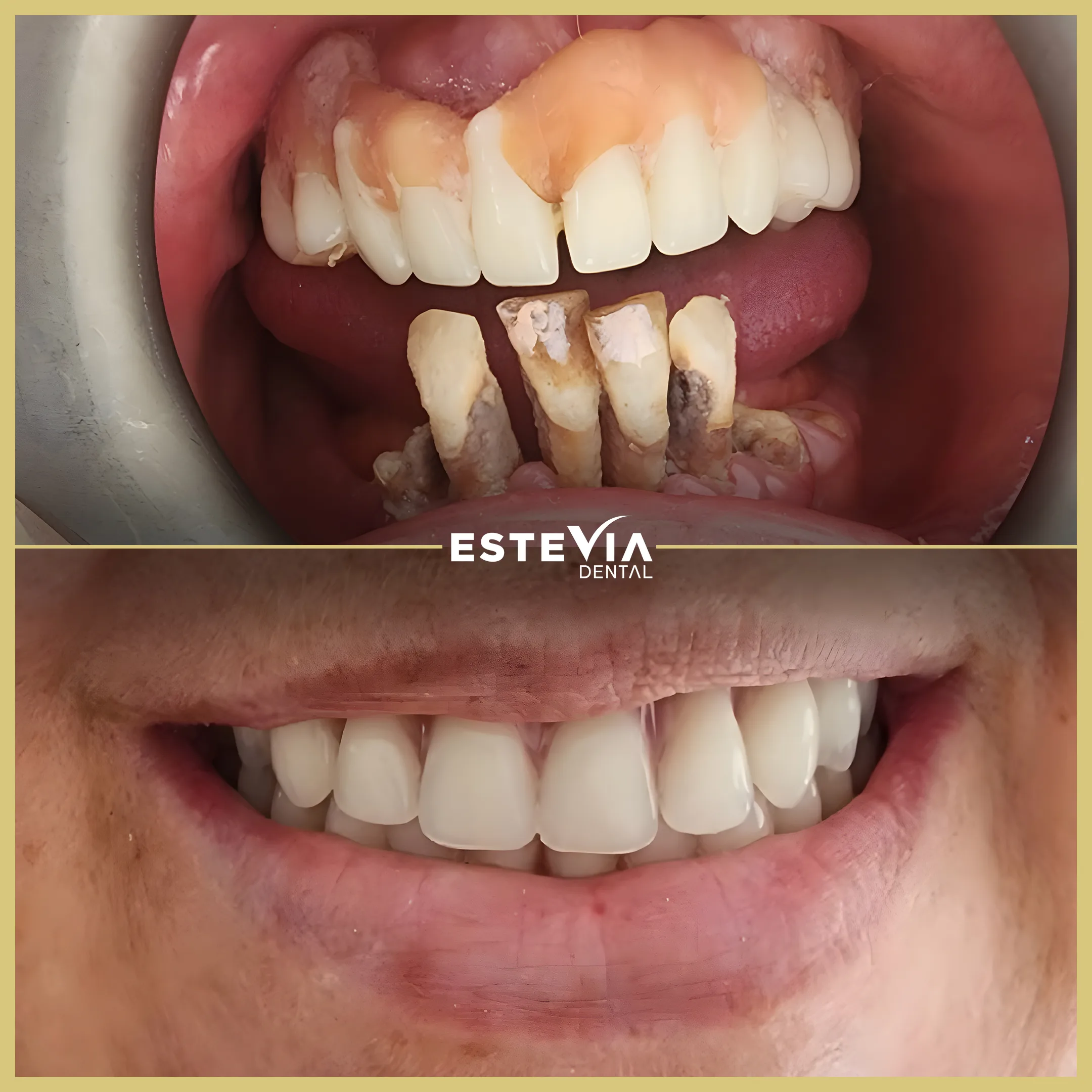 antalya-dis-klinigi-estevia-clinic-1