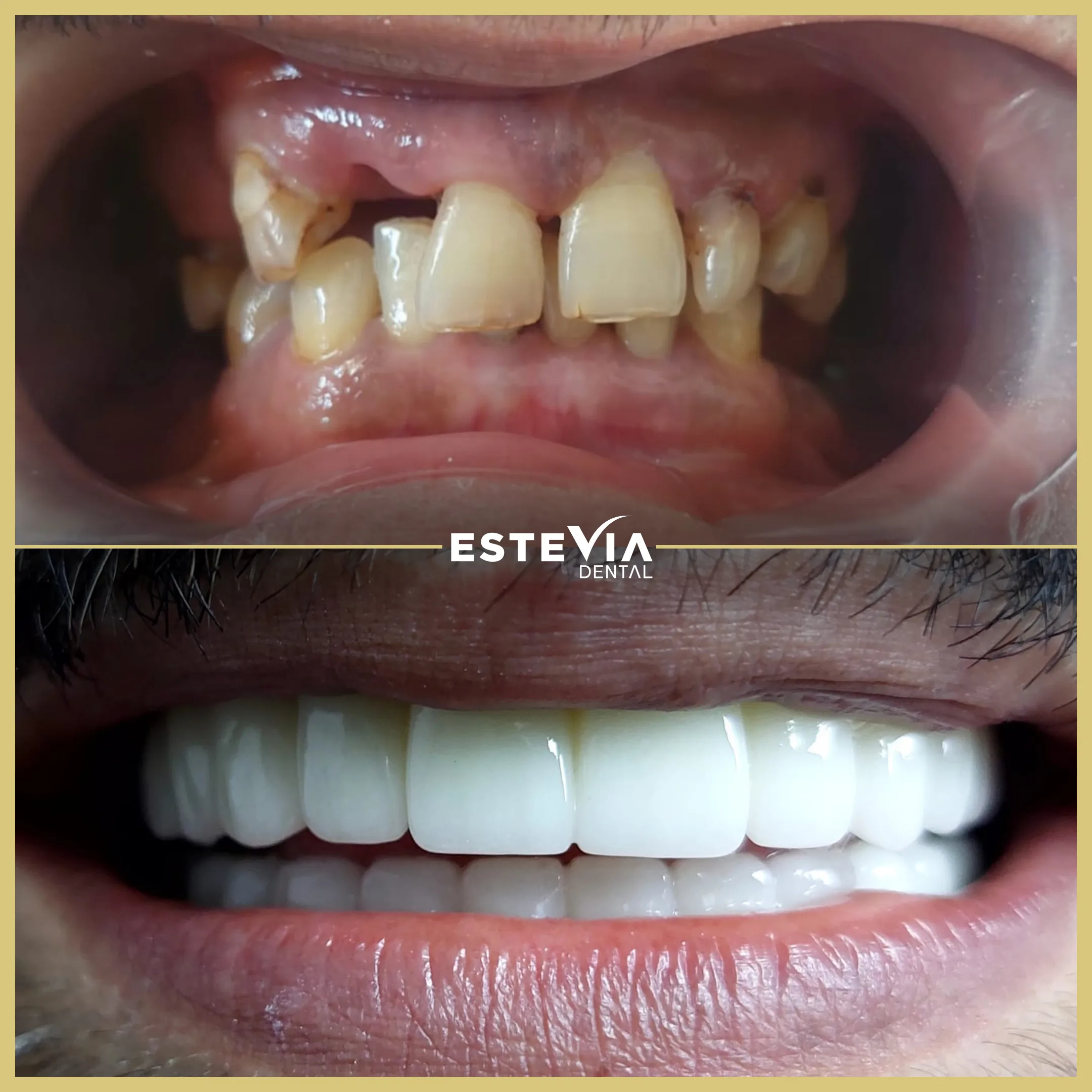 antalya-dis-klinigi-estevia-clinic-12