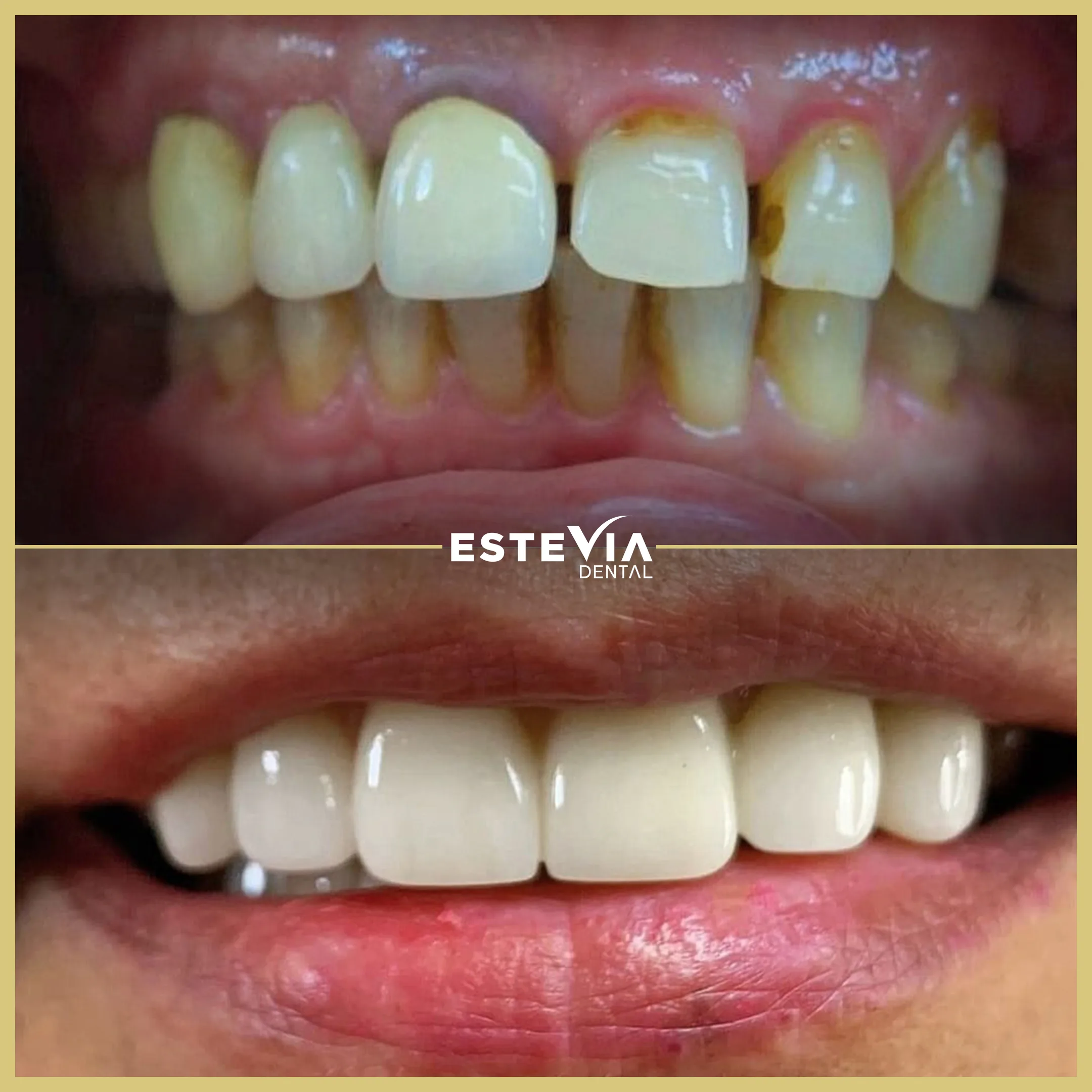 antalya-dis-klinigi-estevia-clinic-13