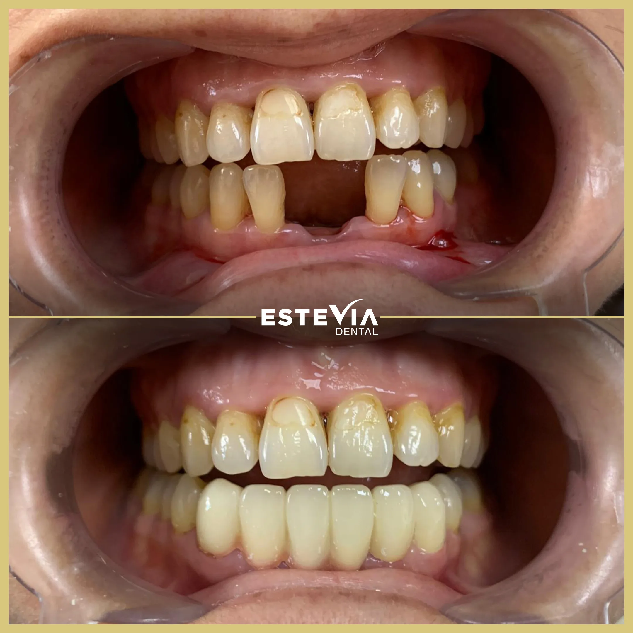 antalya-dis-klinigi-estevia-clinic-14