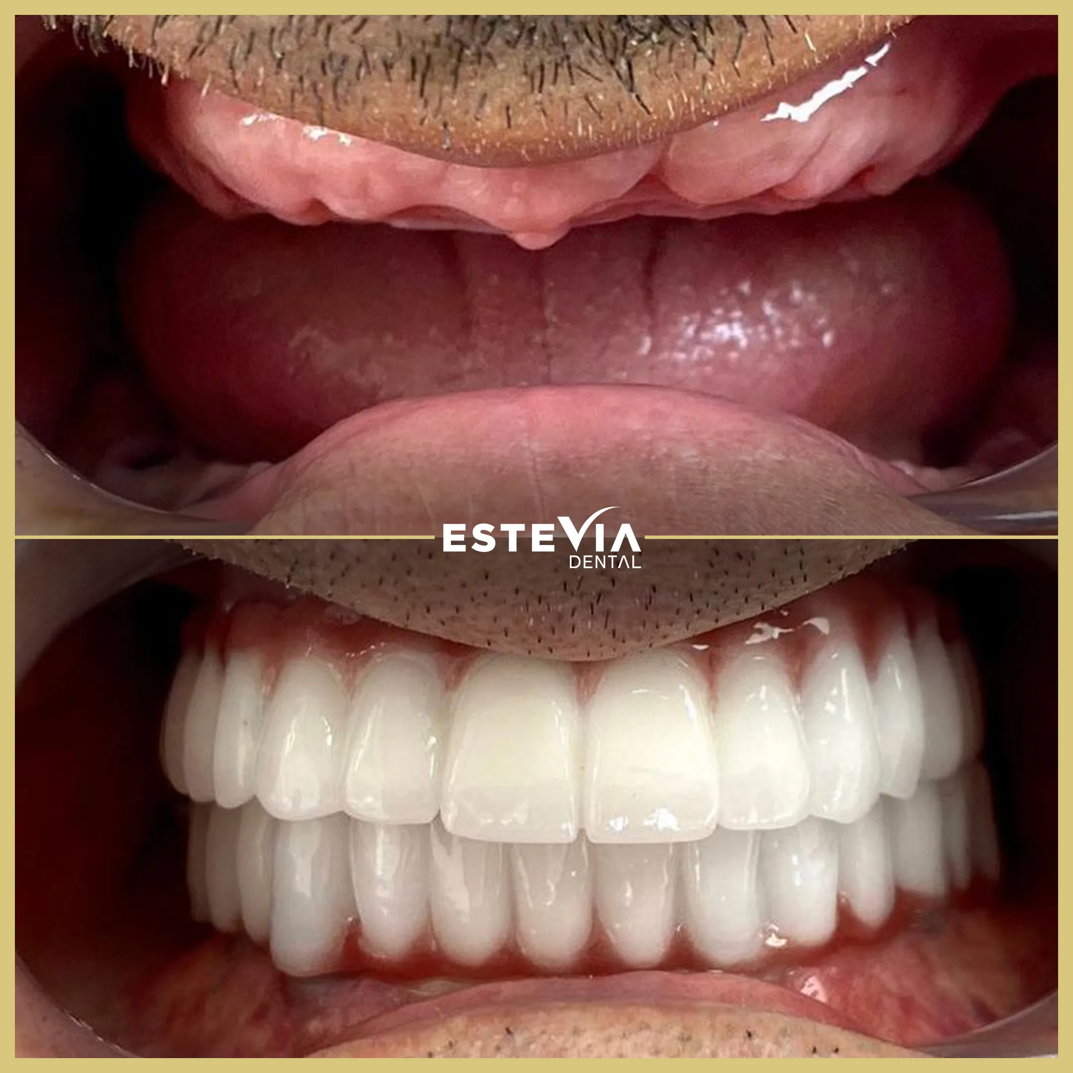 antalya-dis-klinigi-estevia-clinic-18