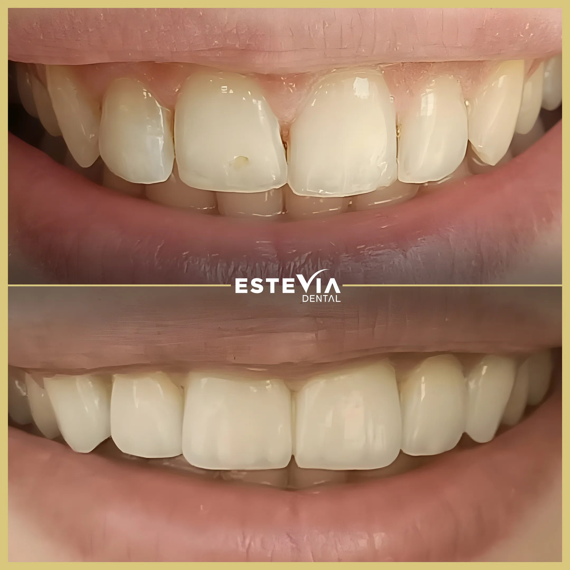 antalya-dis-klinigi-estevia-clinic-2