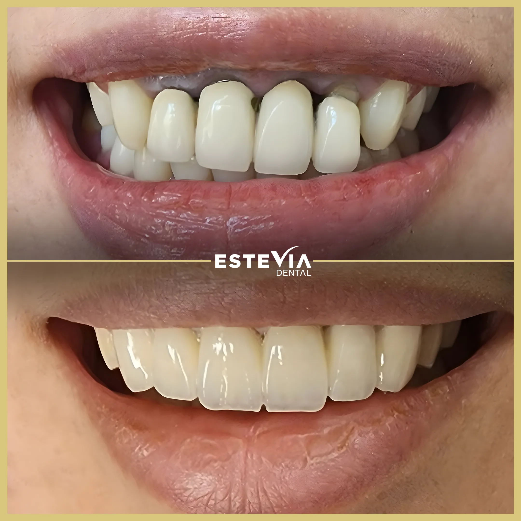 antalya-dis-klinigi-estevia-clinic-3