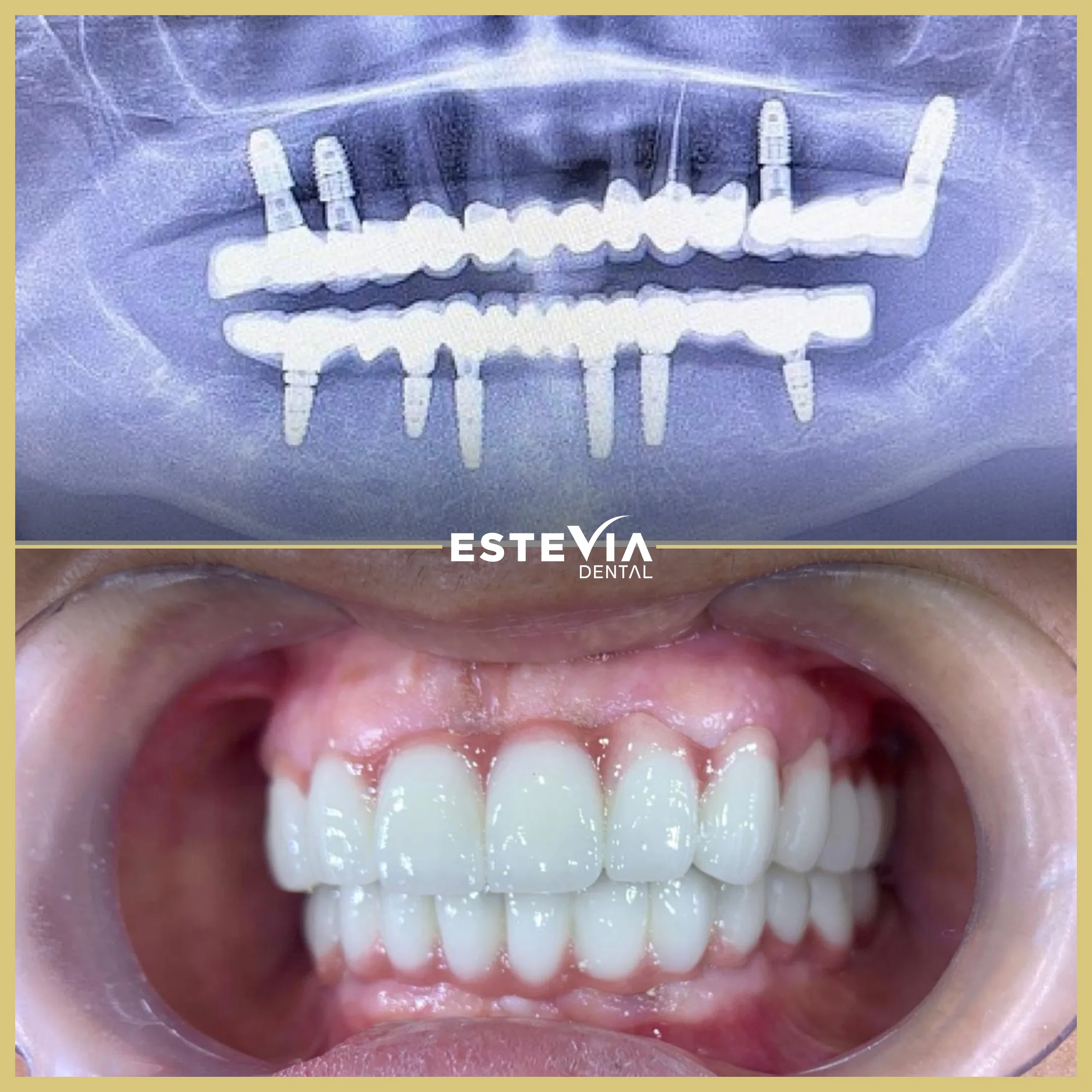 antalya-dis-klinigi-estevia-clinic-7