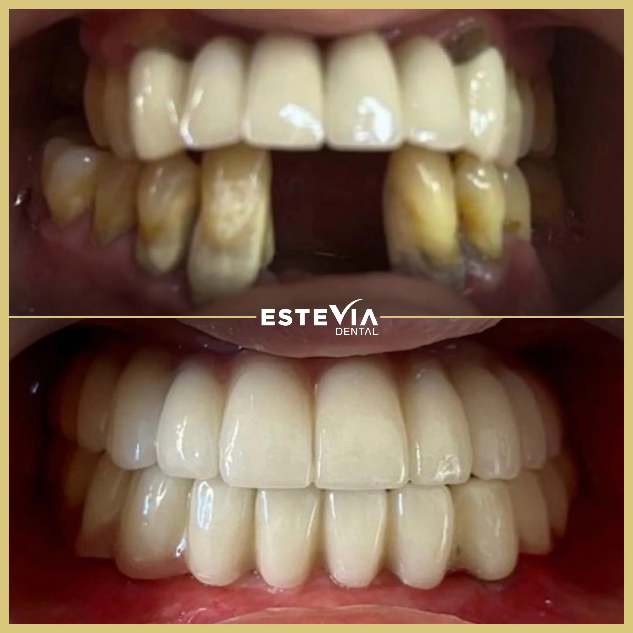 antalya-dis-klinigi-estevia-clinic-9